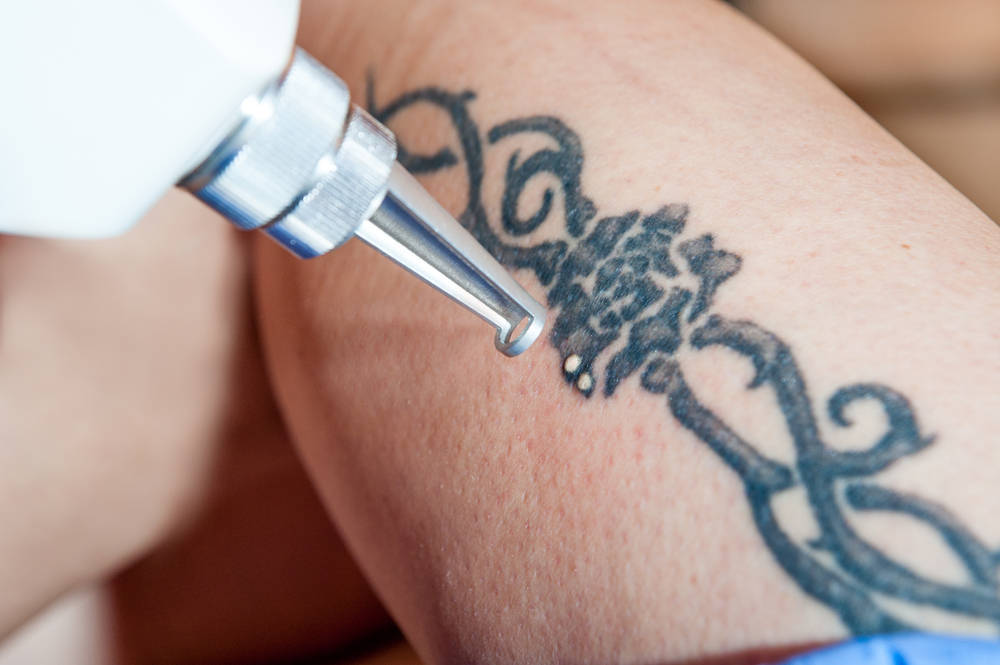 Última tecnología en eliminación de tatuajes